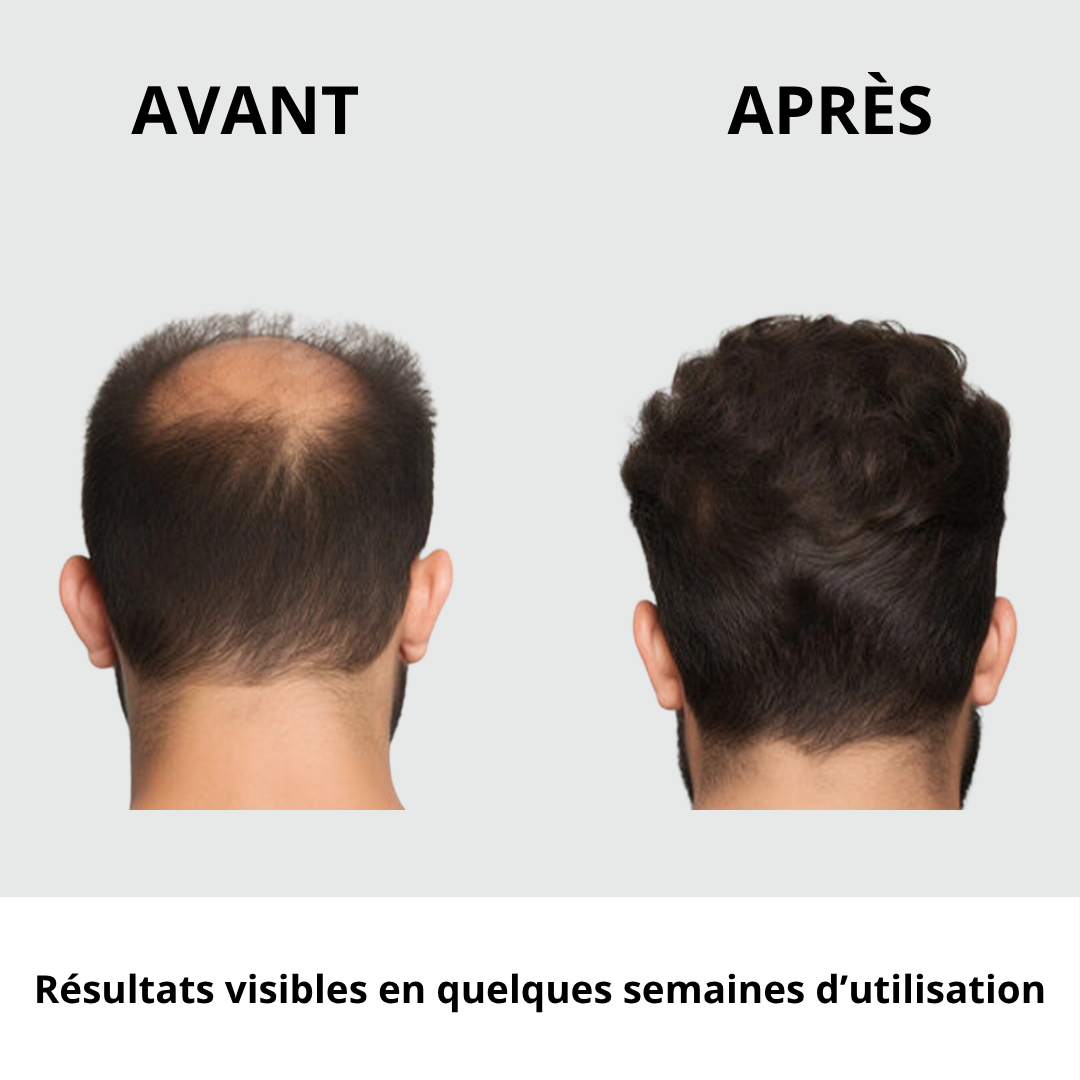 Pommeau filtrant anti chute de cheveux