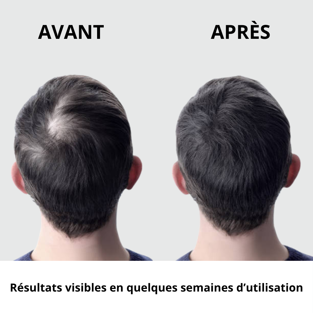 Pommeau filtrant anti chute de cheveux