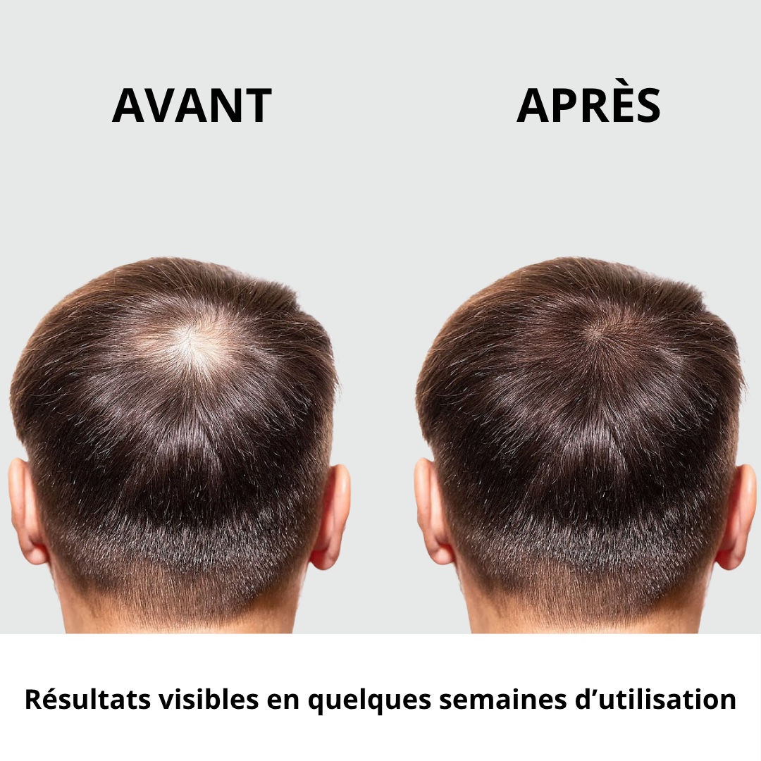 Pommeau filtrant anti chute de cheveux